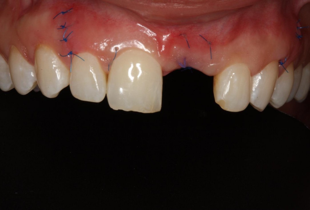 Soft tissue thickening at early implant placement-Puisys