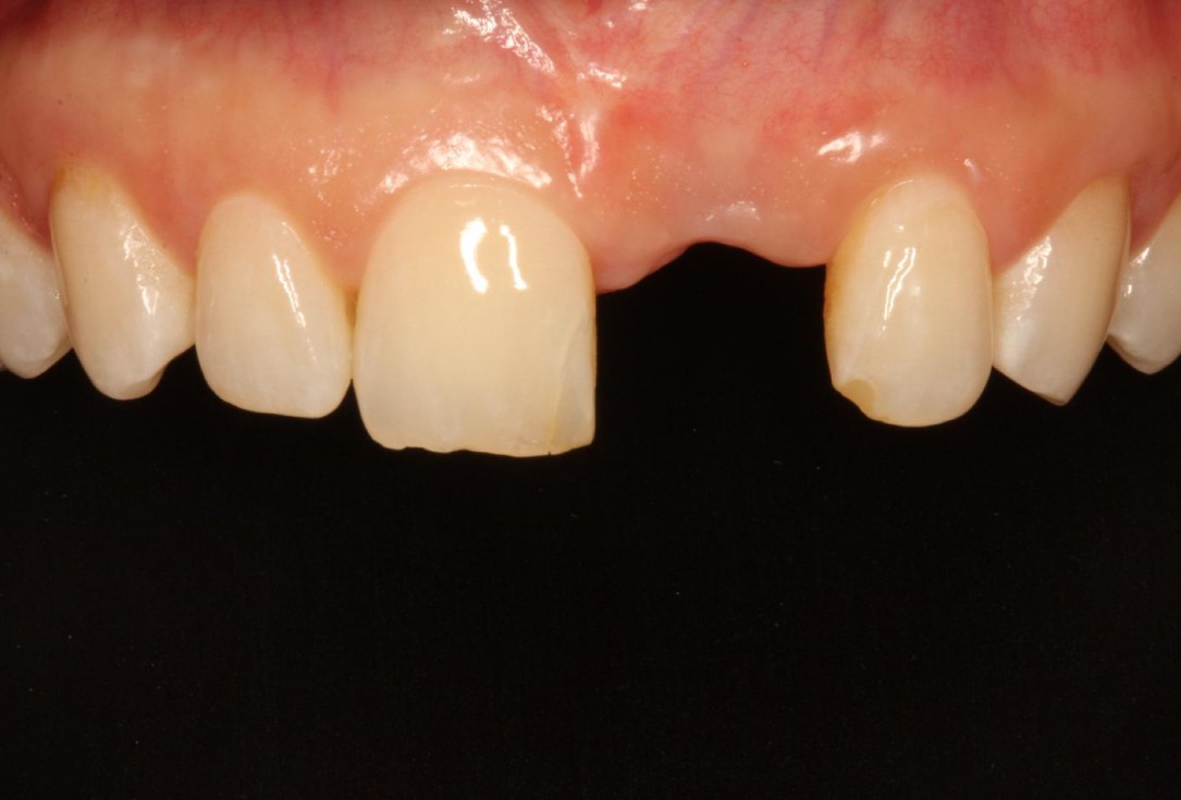 Soft tissue thickening at early implant placement-Puisys