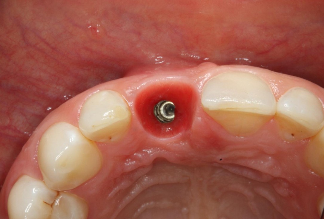 Soft tissue thickening at early implant placement-Puisys