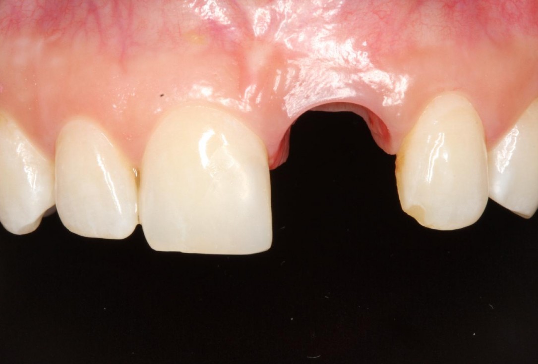 Soft tissue thickening at early implant placement-Puisys