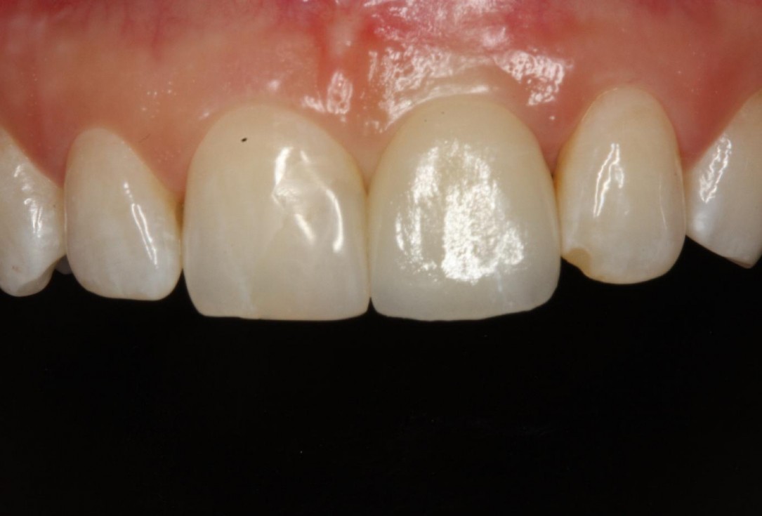 Soft tissue thickening at early implant placement-Puisys