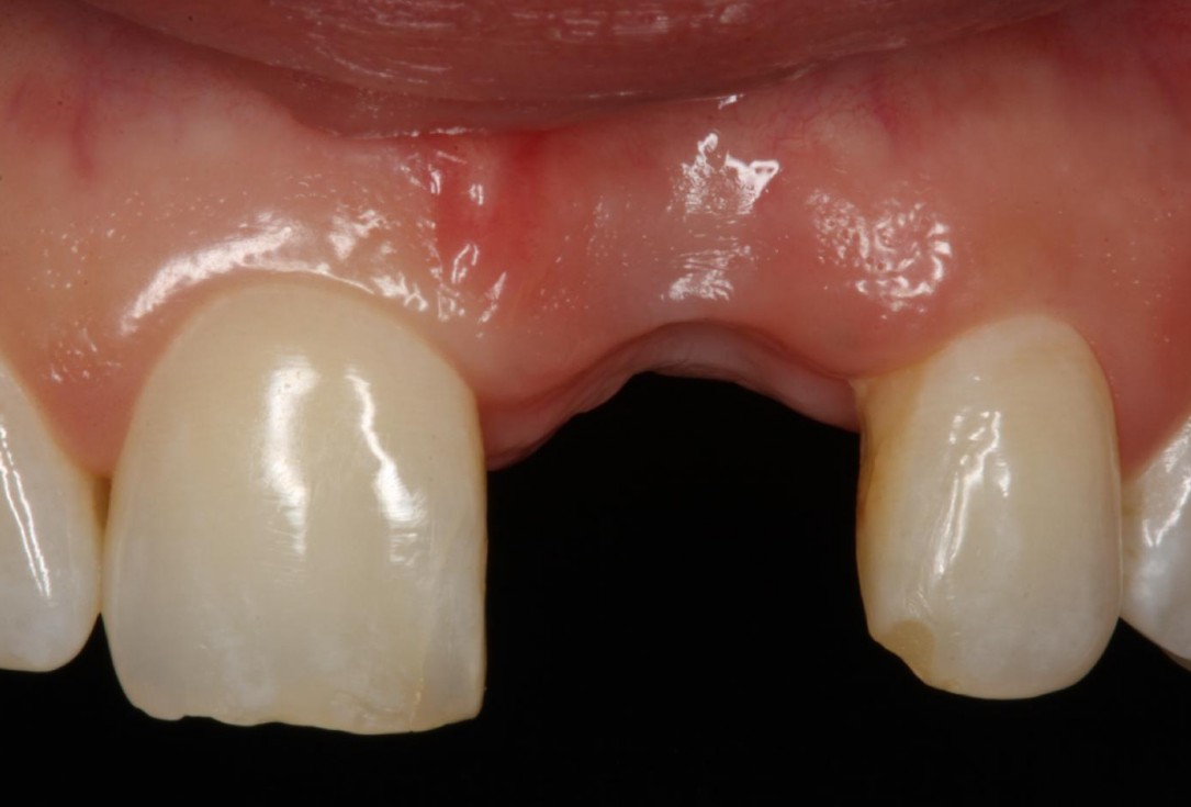 Soft tissue thickening at early implant placement-Puisys