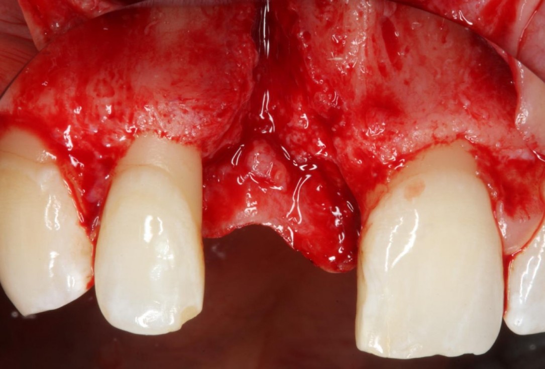 Soft tissue thickening at early implant placement-Puisys