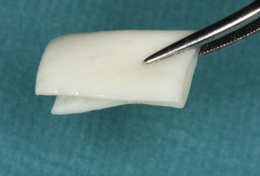 Soft tissue thickening at early implant placement-Puisys