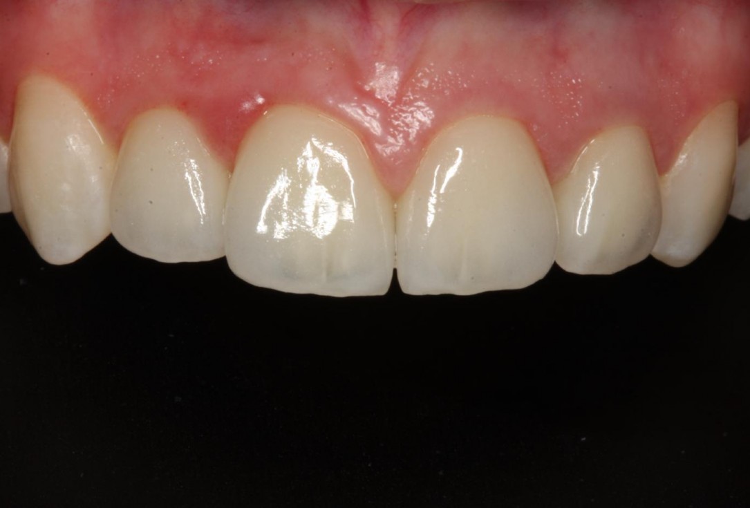 Soft tissue thickening at immediate implant placement with GBR - Dr. A. Puisys