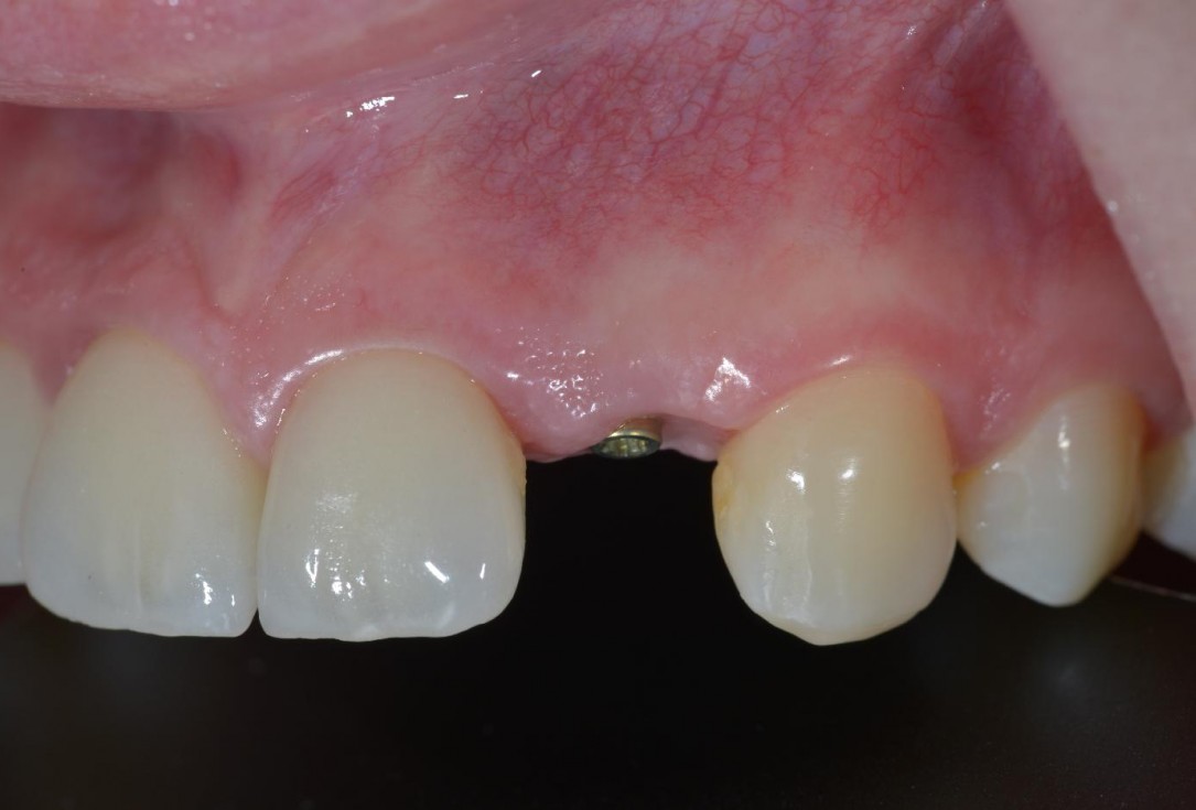 Soft tissue thickening at immediate implant placement with GBR - Dr. A. Puisys