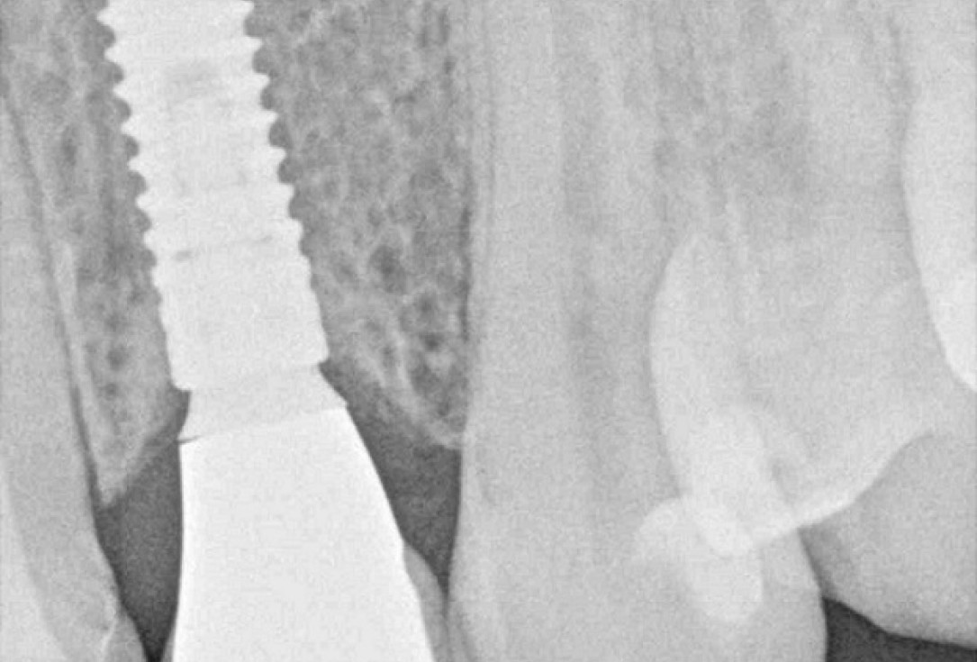 Soft tissue thickening at immediate implant placement with GBR - Dr. A. Puisys