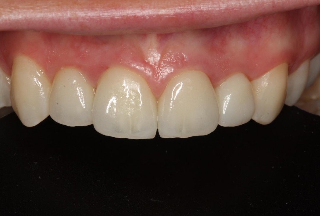 Soft tissue thickening at immediate implant placement with GBR - Dr. A. Puisys
