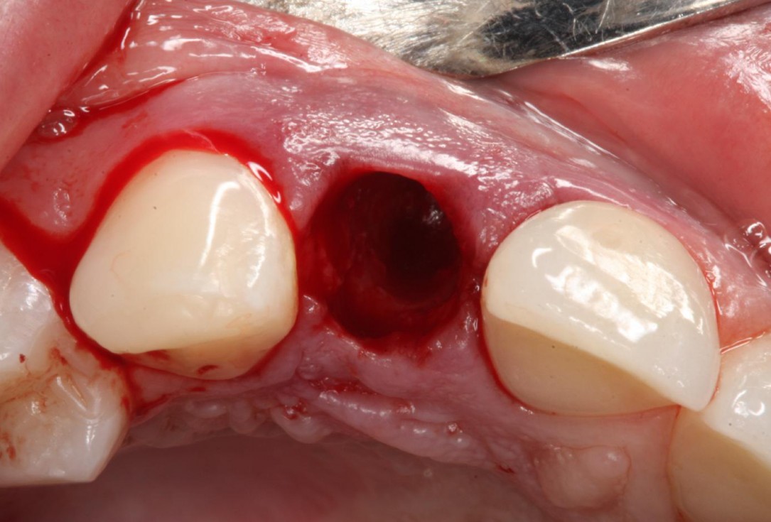 Soft tissue thickening at immediate implant placement with GBR - Dr. A. Puisys