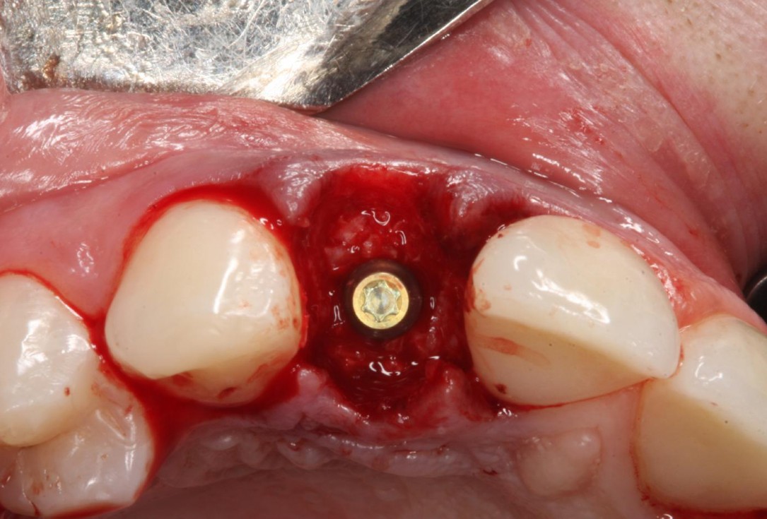 Soft tissue thickening at immediate implant placement with GBR - Dr. A. Puisys