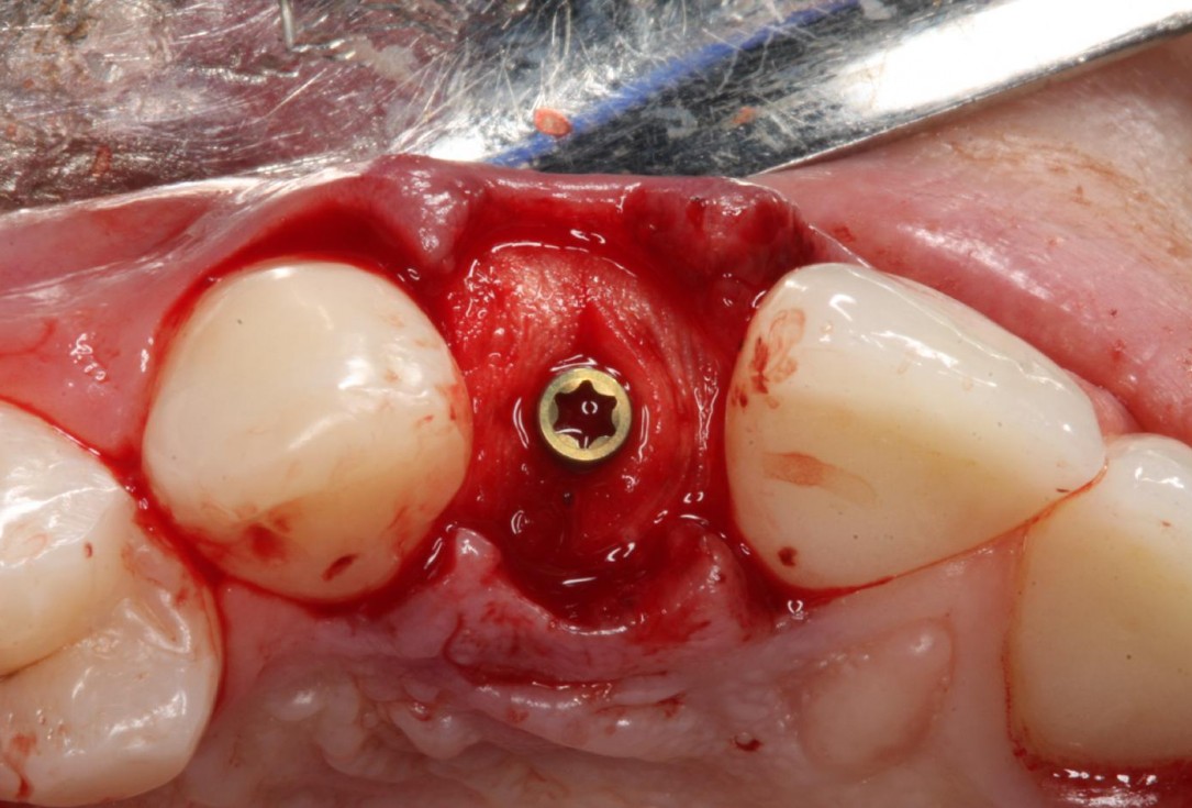 Soft tissue thickening at immediate implant placement with GBR - Dr. A. Puisys