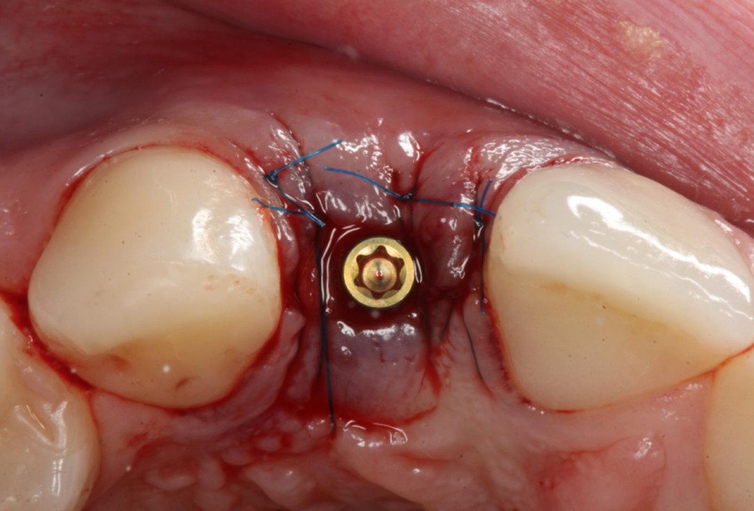 Soft tissue thickening at immediate implant placement with GBR - Dr. A. Puisys