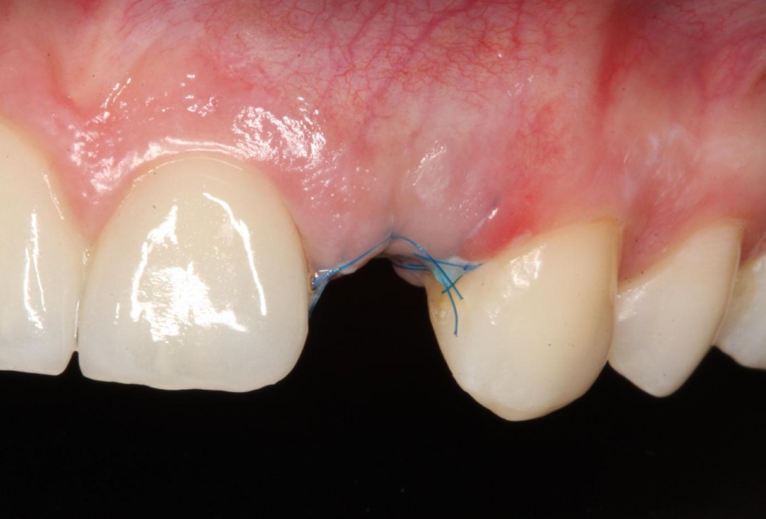 Soft tissue thickening at immediate implant placement with GBR - Dr. A. Puisys