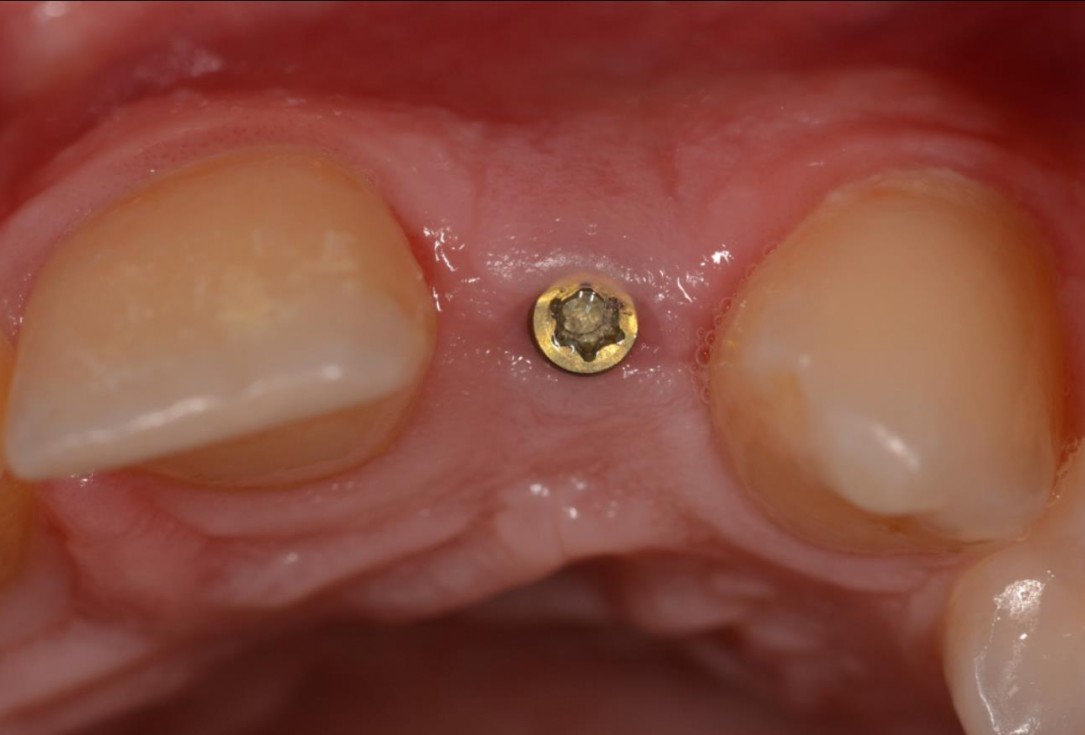Soft tissue augmentation around missing lateral incisors- Mirisola