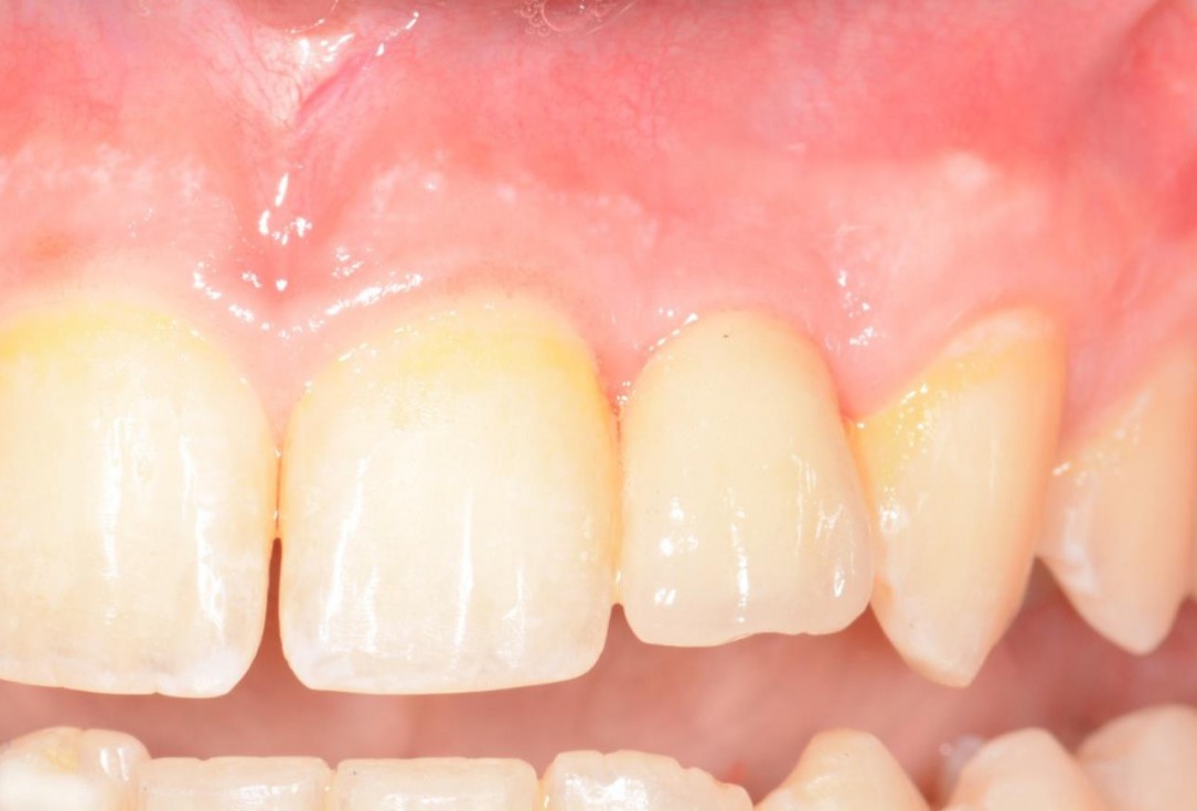 Soft tissue augmentation around missing lateral incisors- Mirisola