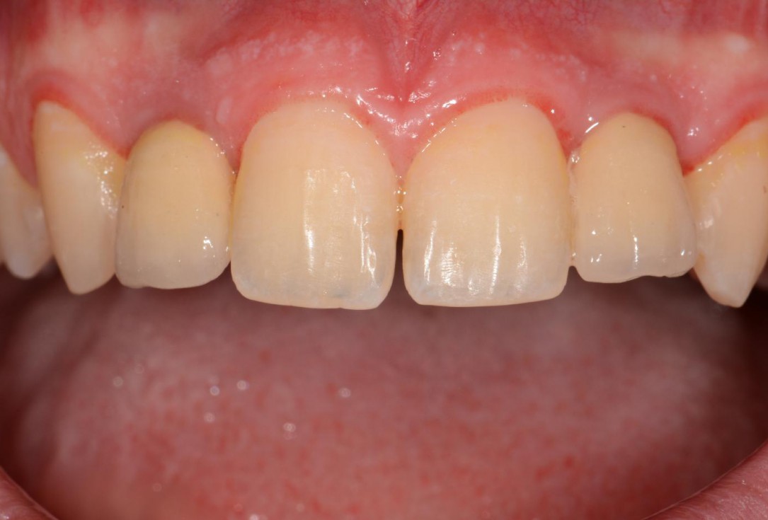 Soft tissue augmentation around missing lateral incisors- Mirisola