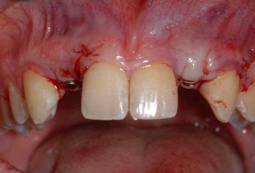 Soft tissue augmentation around missing lateral incisors- Mirisola