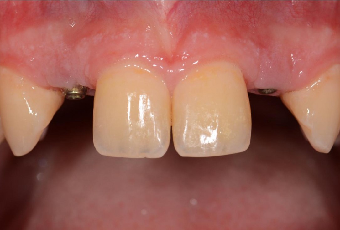 Soft tissue augmentation around missing lateral incisors- Mirisola