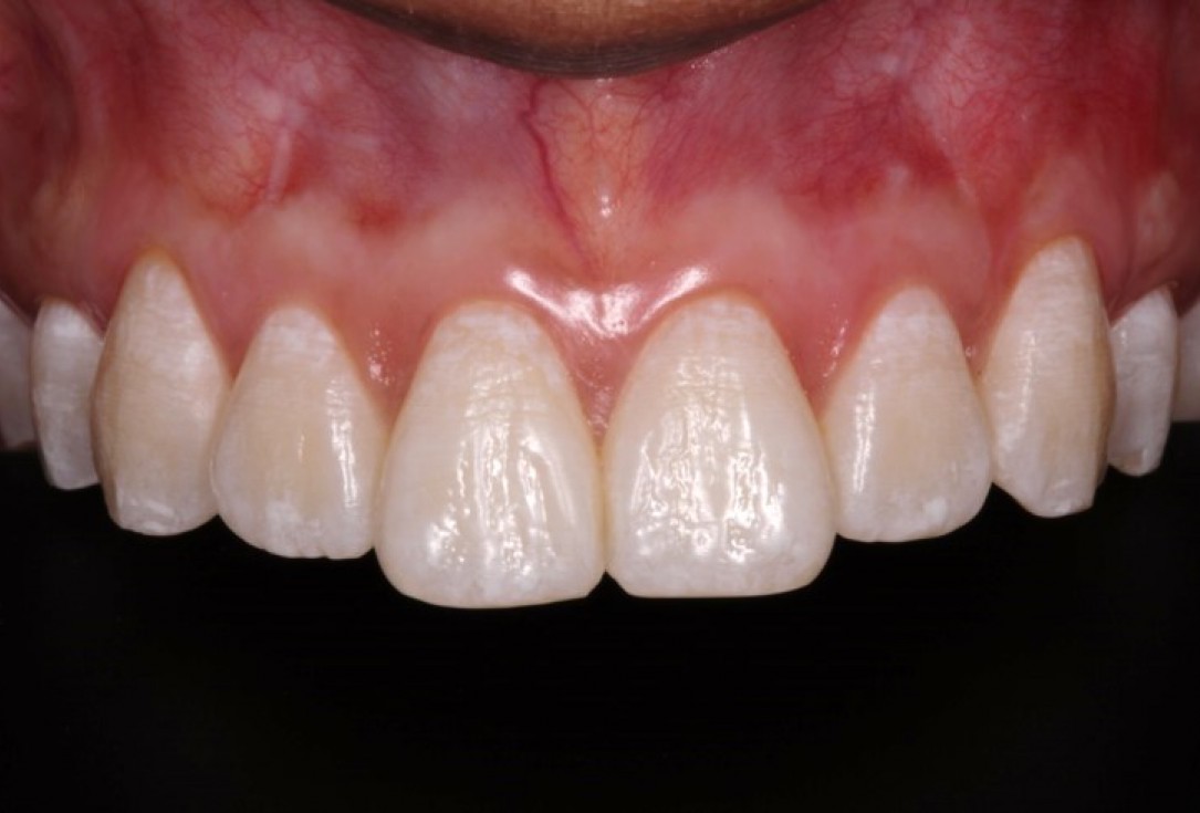 Isolated gingival recessions treated by CAF in conjunction with mucoderm® and Straumann® Emdogain® - Taba Jr