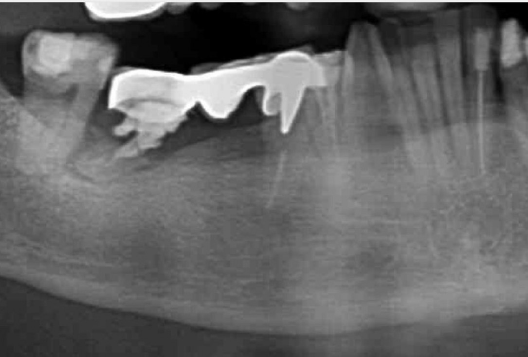 1/9 Peri-implant soft tissue augmentation for pontic-Frosecchi