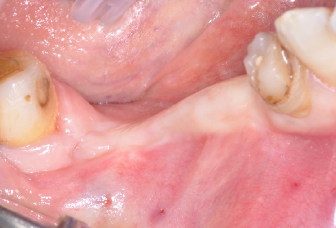 2/9 Peri-implant soft tissue augmentation for pontic-Frosecchi