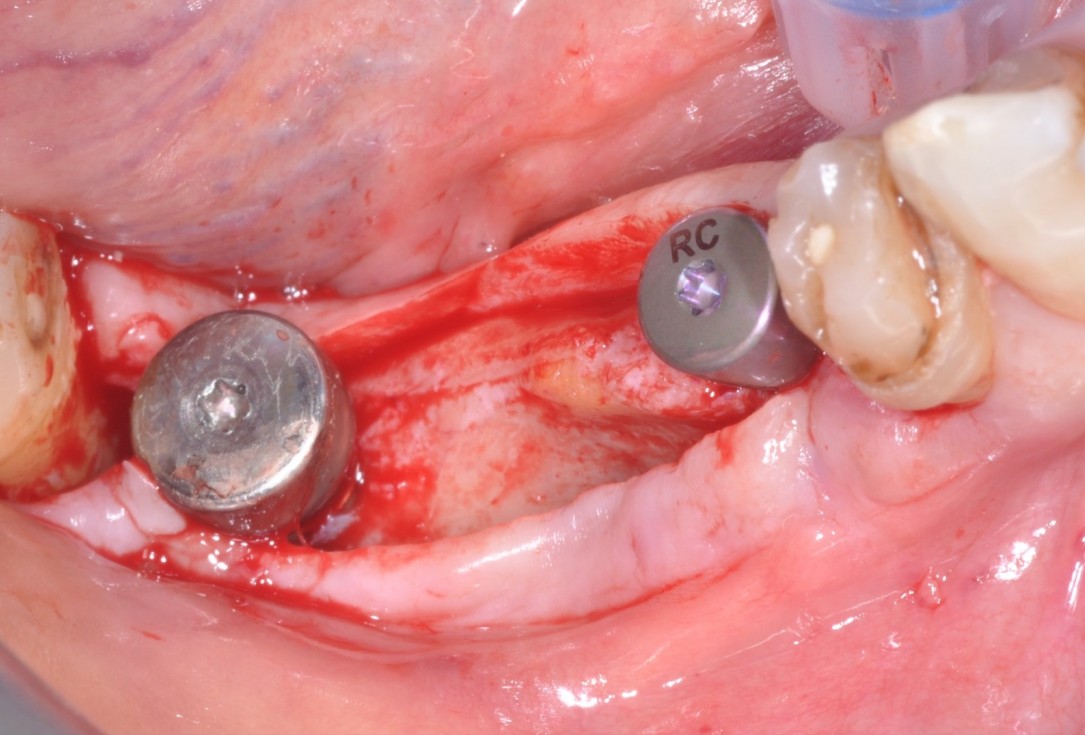 3/9 Peri-implant soft tissue augmentation for pontic-Frosecchi
