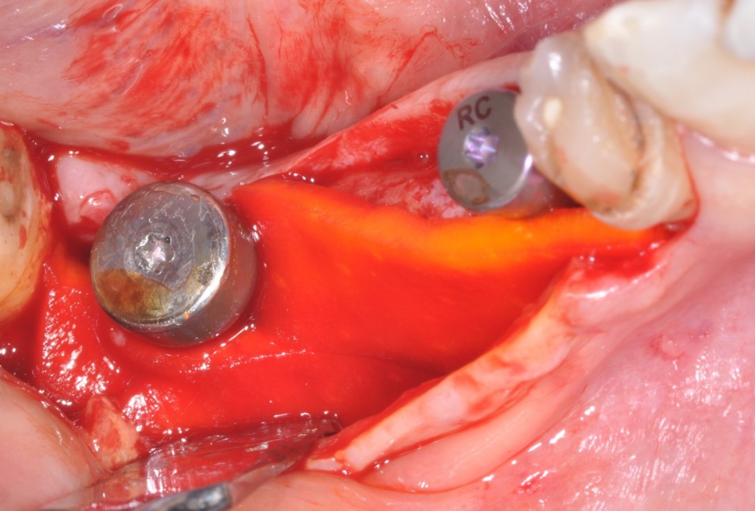 5/9 Peri-implant soft tissue augmentation for pontic-Frosecchi