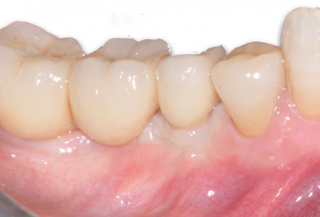 8/9 Peri-implant soft tissue augmentation for pontic-Frosecchi