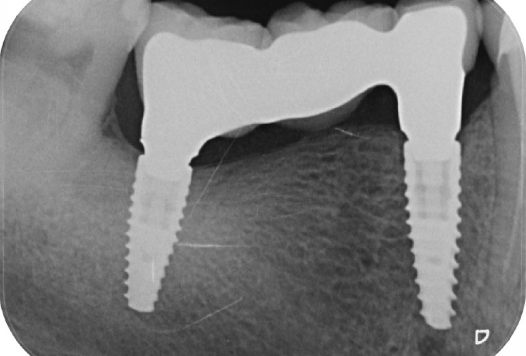 9/9 Peri-implant soft tissue augmentation for pontic-Frosecchi