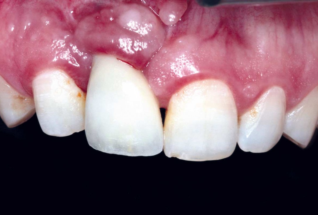 Treatment of a failed implant in the aesthetic zone - Dr. S. Pelekanos