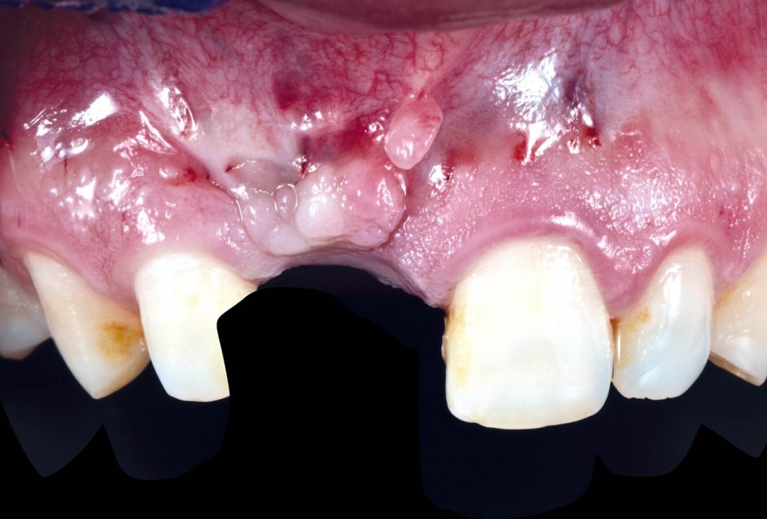 Treatment of a failed implant in the aesthetic zone - Dr. S. Pelekanos