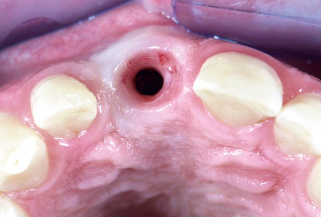 Treatment of a failed implant in the aesthetic zone - Dr. S. Pelekanos