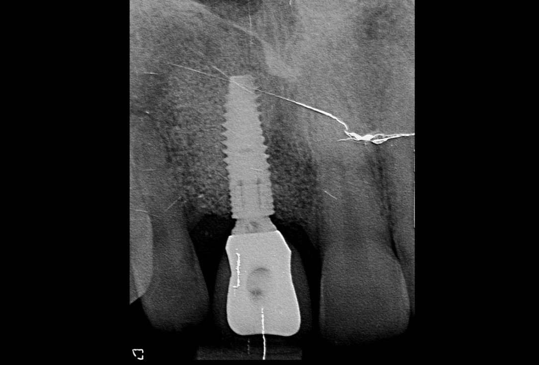 Treatment of a failed implant in the aesthetic zone - Dr. S. Pelekanos
