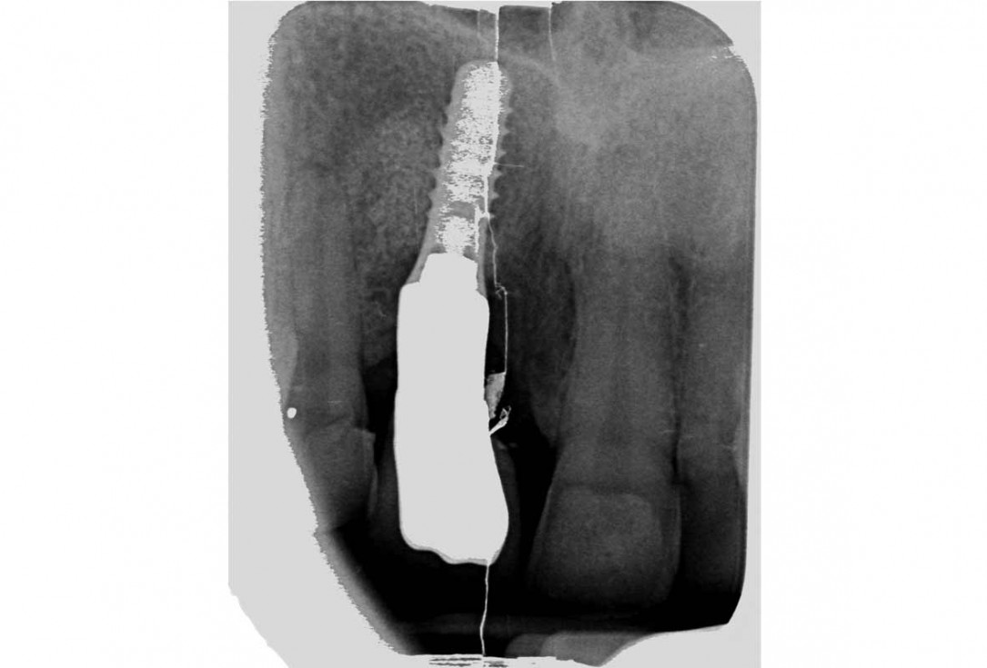 Treatment of a failed implant in the aesthetic zone - Dr. S. Pelekanos