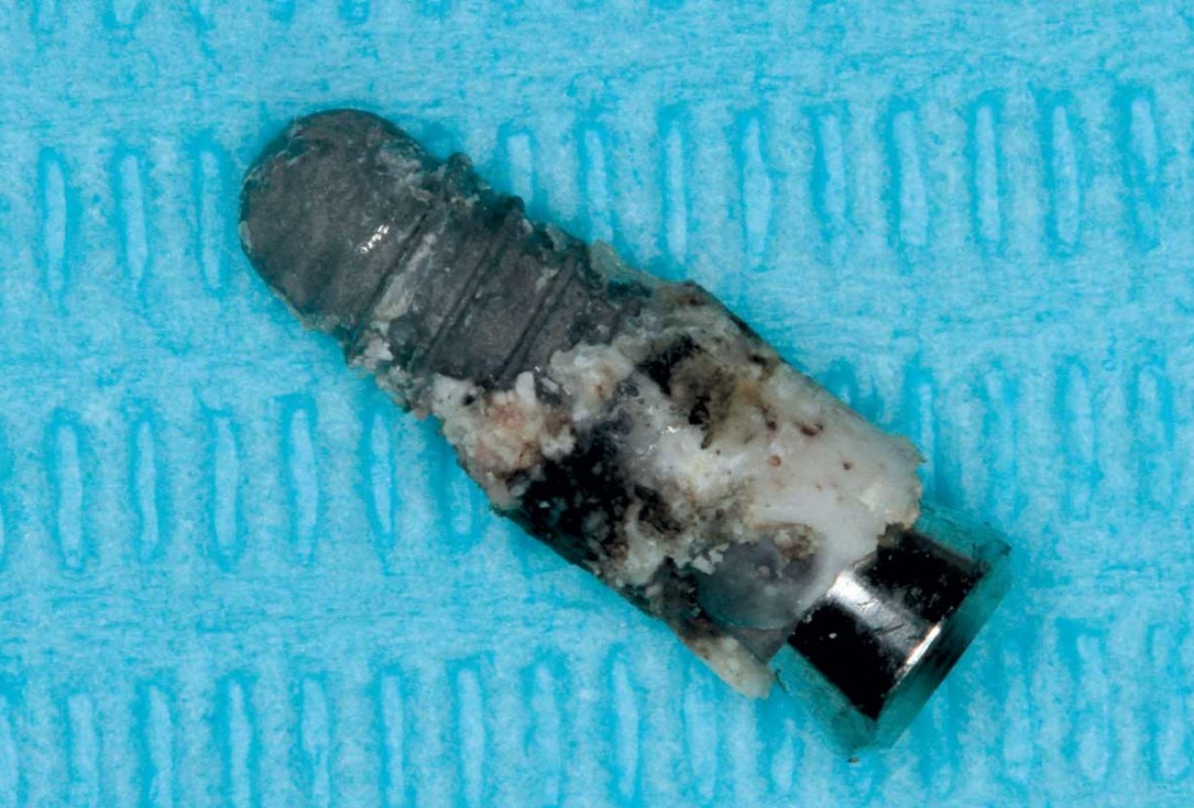 Treatment of a failed implant in the aesthetic zone - Dr. S. Pelekanos