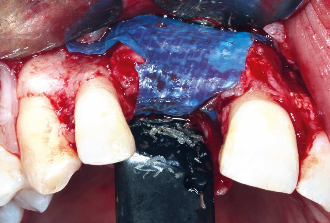 Treatment of a failed implant in the aesthetic zone - Dr. S. Pelekanos