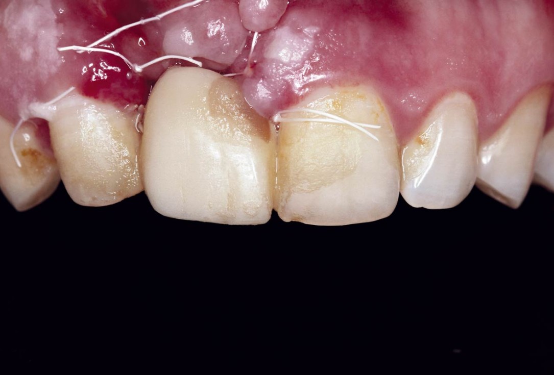 Treatment of a failed implant in the aesthetic zone - Dr. S. Pelekanos