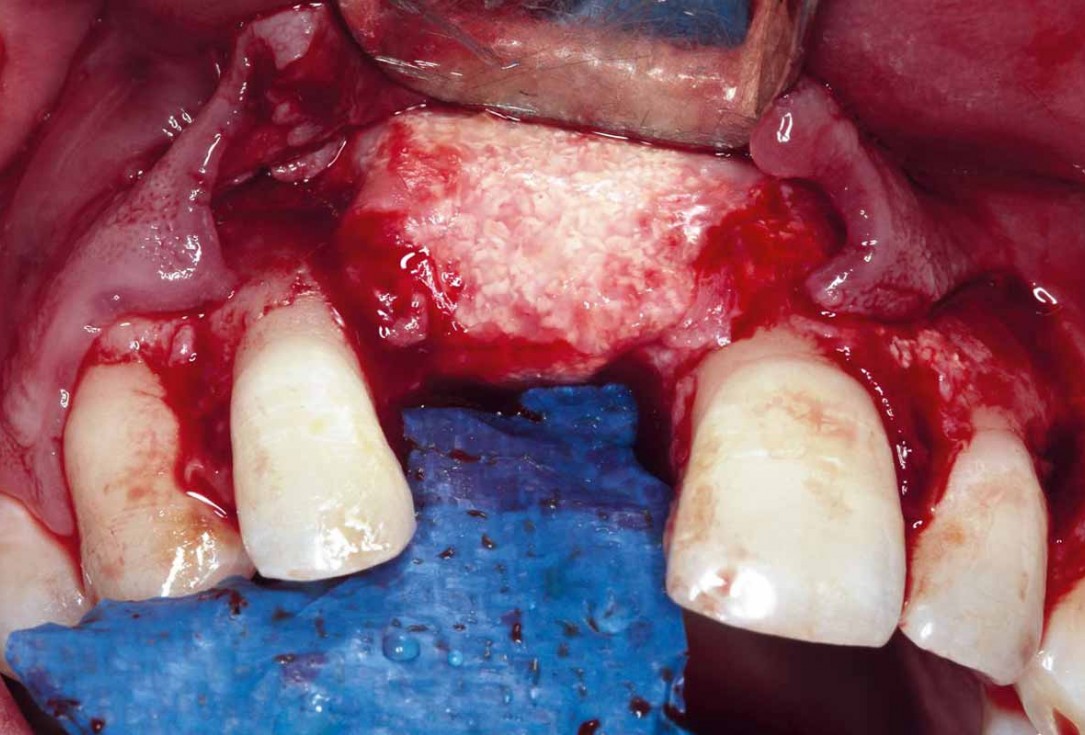 Treatment of a failed implant in the aesthetic zone - Dr. S. Pelekanos