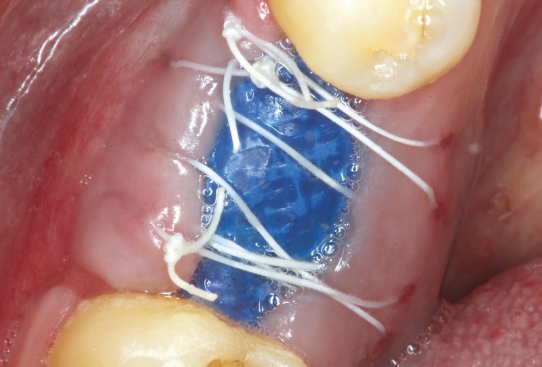 Covering of an immediately placed implant with permamem® - Prof. Z. Mazor