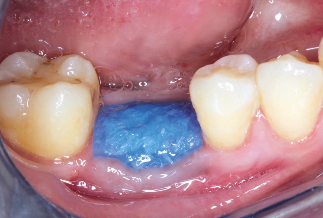 Covering of an immediately placed implant with permamem® - Prof. Z. Mazor