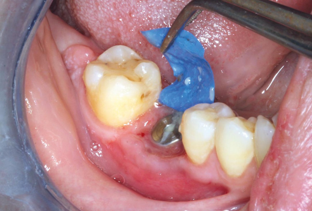 Covering of an immediately placed implant with permamem® - Prof. Z. Mazor