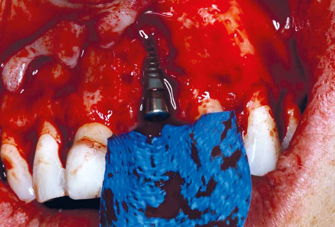 Implant placement and bone augmentation in the aesthetic zone using maxgraft® and permamem® - Dr. A. Puišys