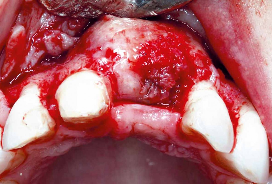 Implant placement and bone augmentation in the aesthetic zone using maxgraft® and permamem® - Dr. A. Puišys