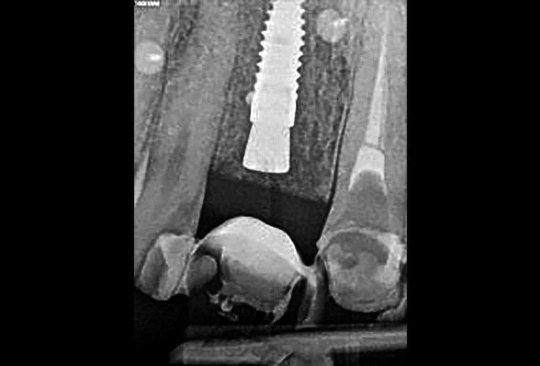 Implant placement and bone augmentation in the aesthetic zone using maxgraft® and permamem® - Dr. A. Puišys