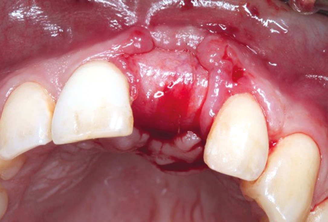 Ridge preservation with permamem®, maxgraft® granules and autologous bone - Dr. E. Valdimarsson