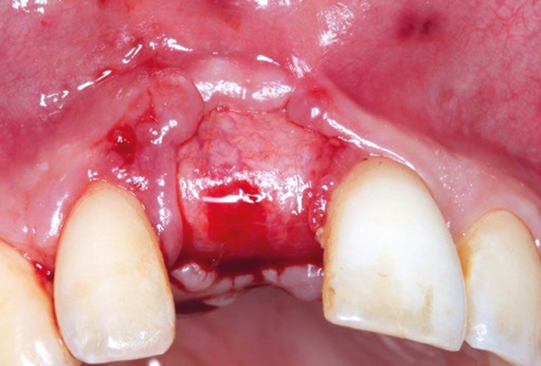 Ridge preservation with permamem®, maxgraft® granules and autologous bone - Dr. E. Valdimarsson