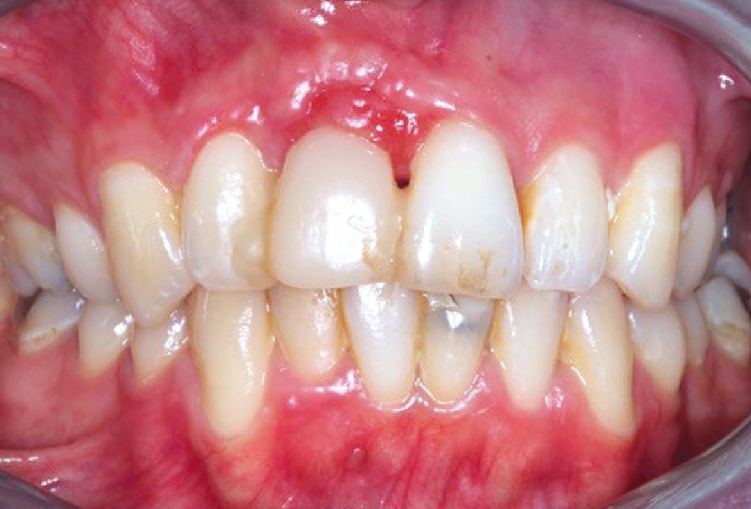 Ridge preservation with permamem®, maxgraft® granules and autologous bone - Dr. E. Valdimarsson