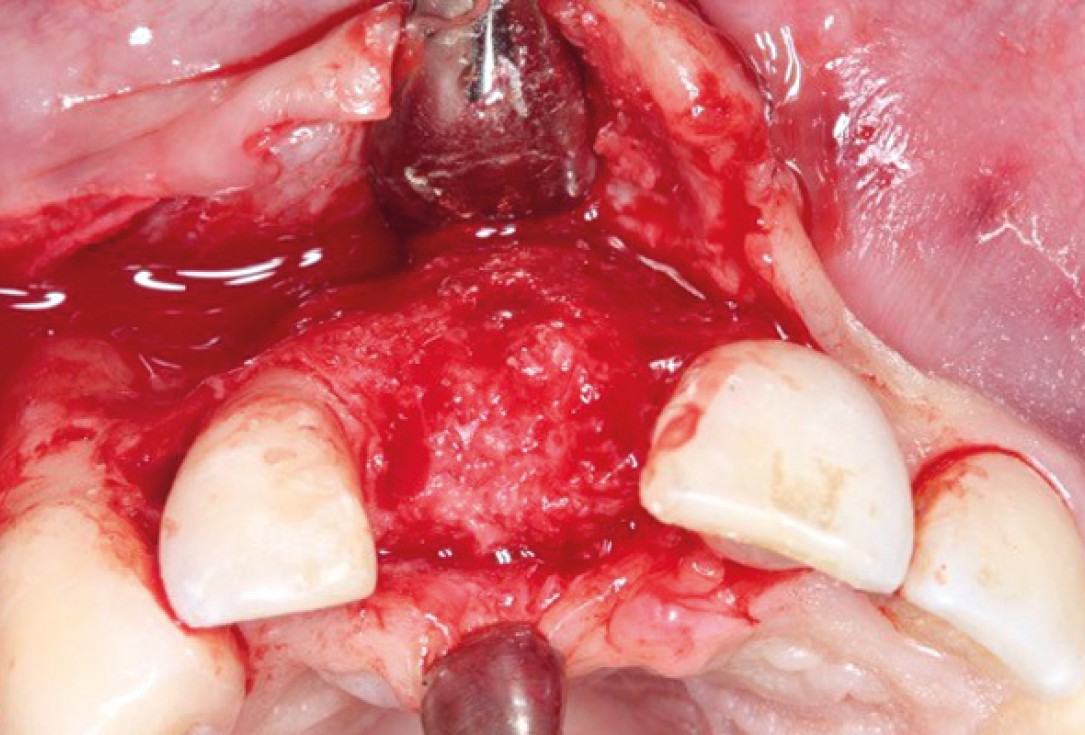 Ridge preservation with permamem®, maxgraft® granules and autologous bone - Dr. E. Valdimarsson