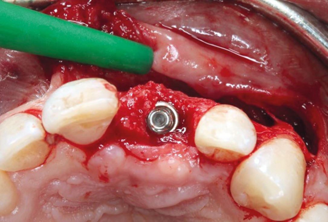 Ridge preservation with permamem®, maxgraft® granules and autologous bone - Dr. E. Valdimarsson