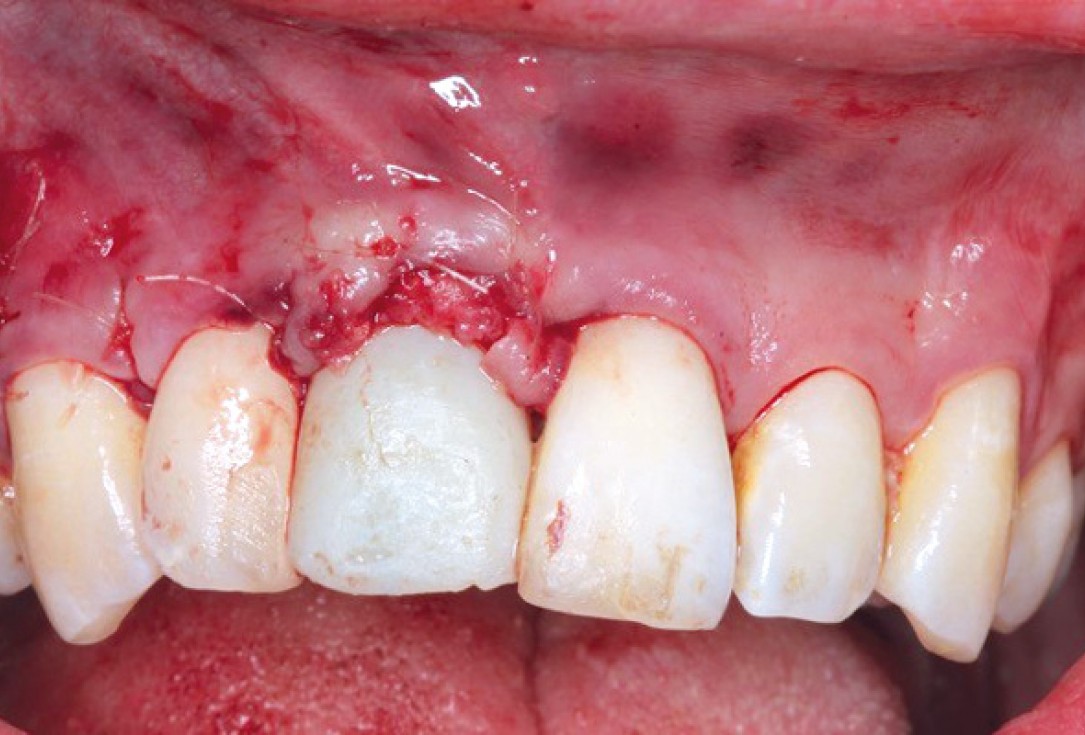 Ridge preservation with permamem®, maxgraft® granules and autologous bone - Dr. E. Valdimarsson